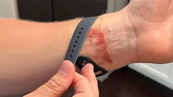 Iritație a pielii sub o curea din silicon Apple Watch